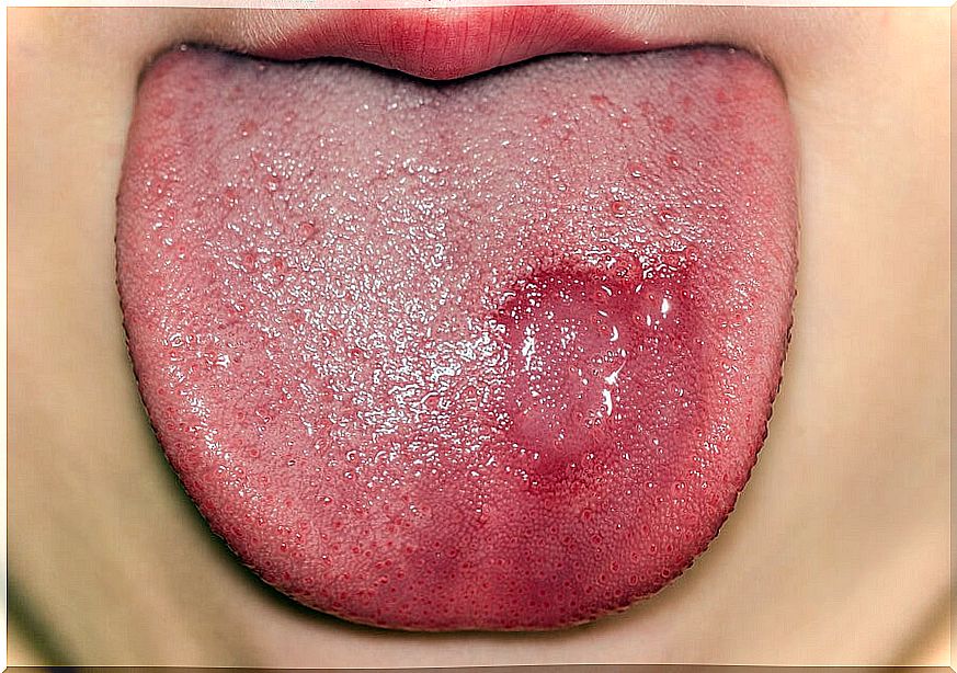 Geographic tongue in children: symptoms and treatment