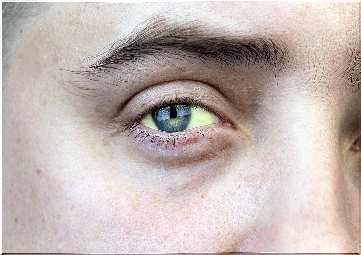 Woman with yellow eyes from hepatitis C.