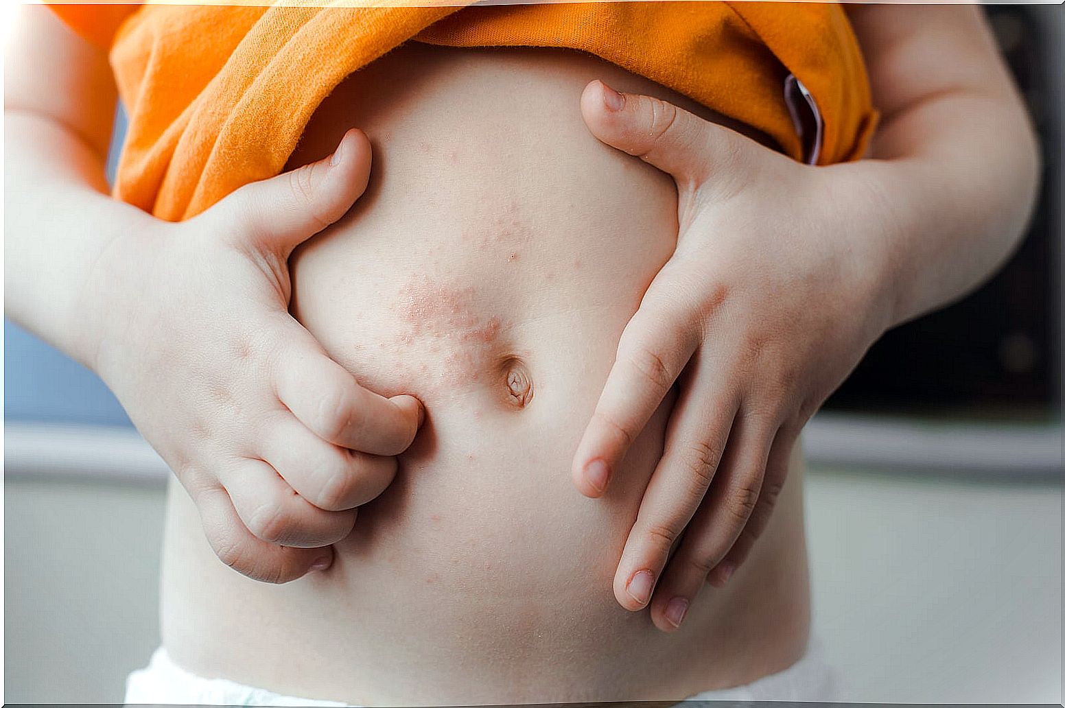 Scabies in children: symptoms, causes and treatment