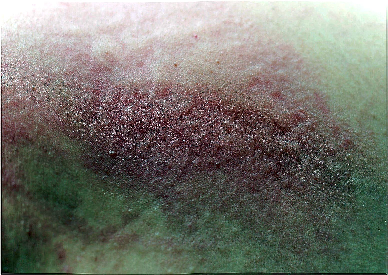 Scabies skin in children.