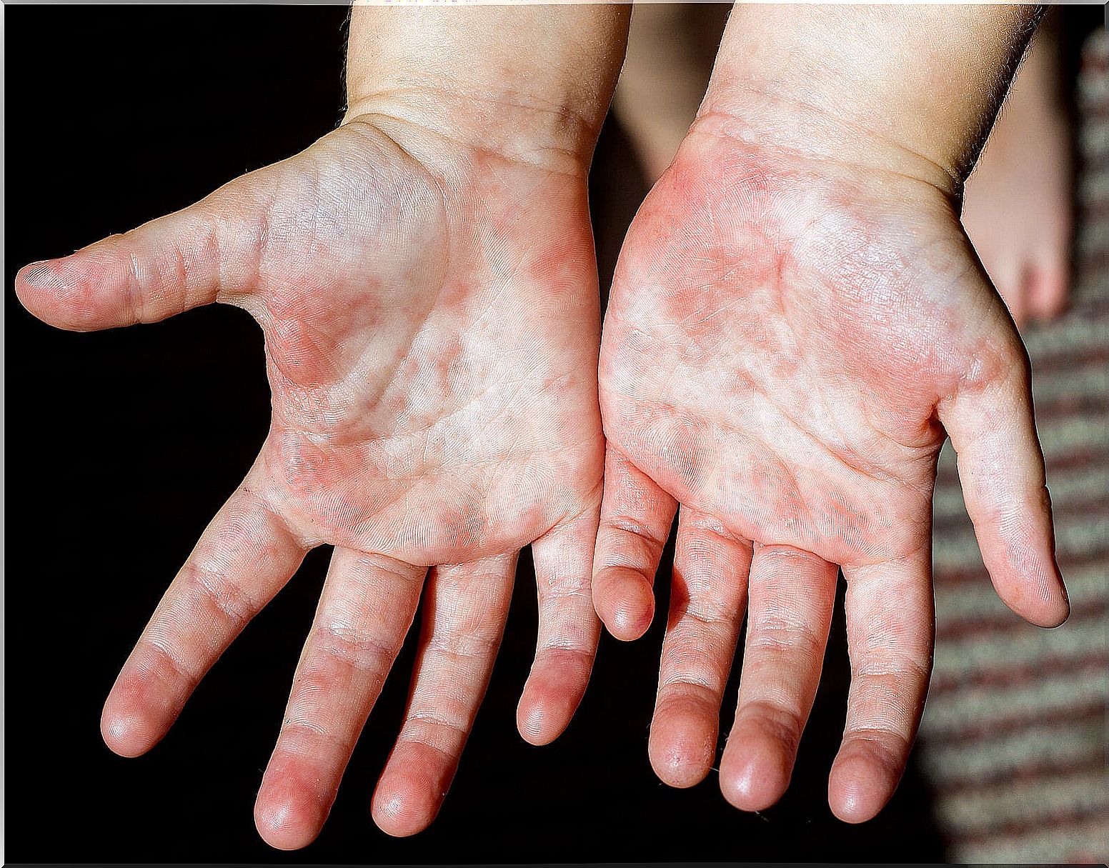 The 10 most common skin diseases in children